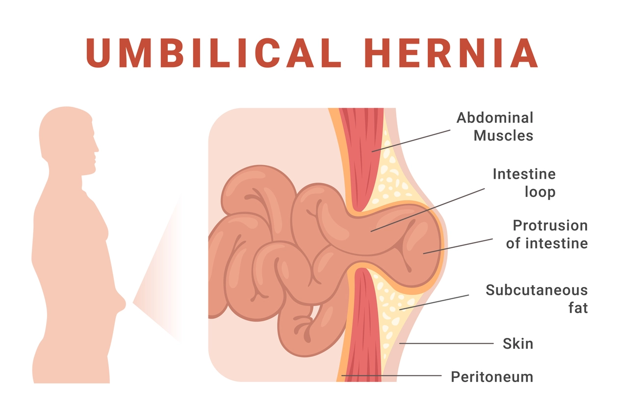 Laparoscopic Umbilical Hernia Repair - Johns Creek, Alpharetta, Roswell, Atlanta
